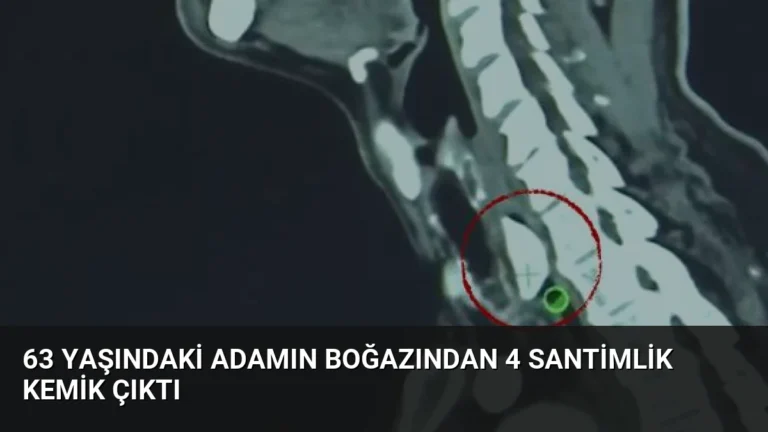 63 Yaşındaki Adamın Boğazından 4 Santimlik Kemik Çıktı