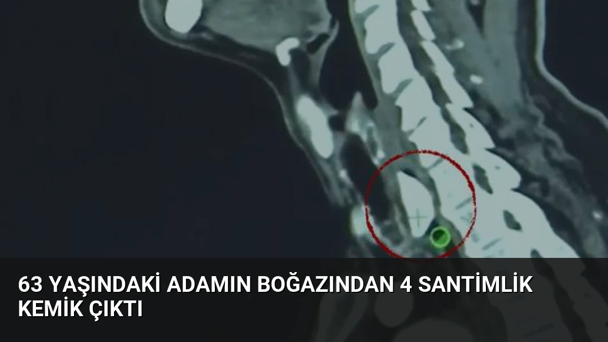 63 Yaşındaki Adamın Boğazından 4 Santimlik Kemik Çıktı