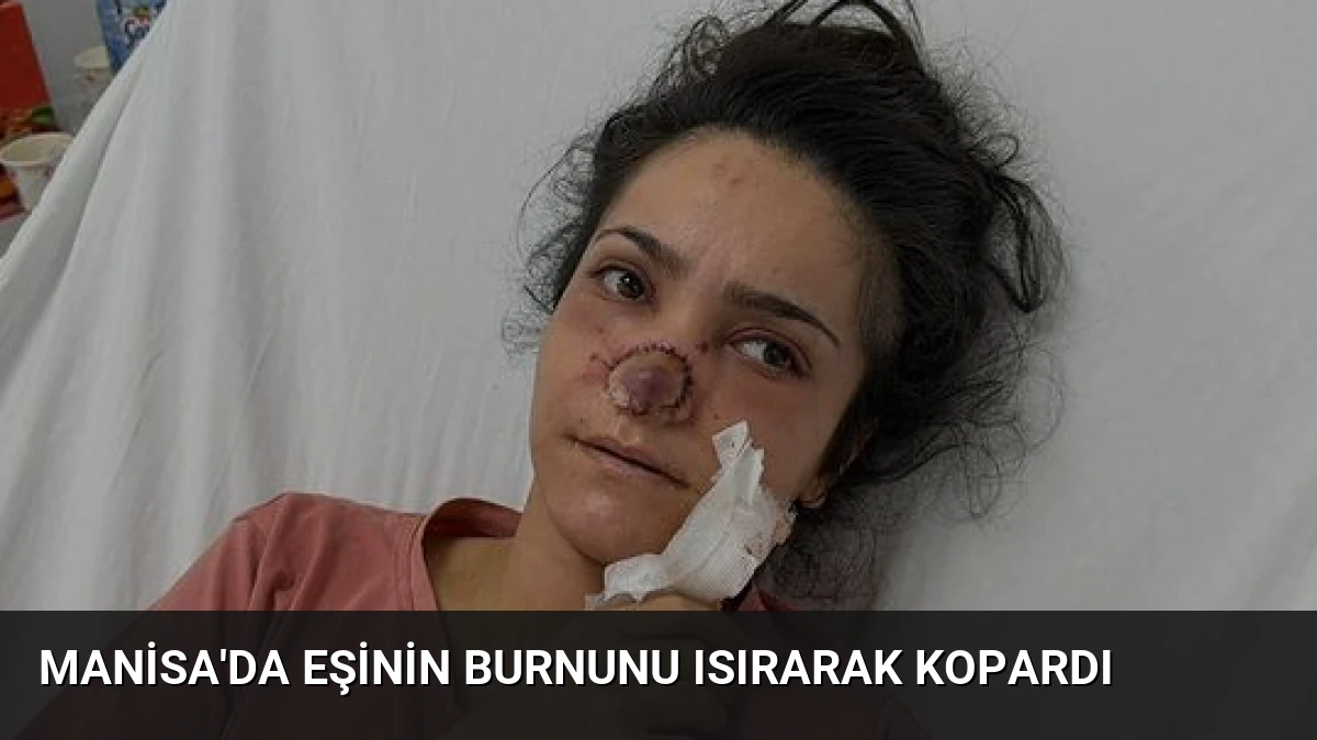 Manisa’da Eşinin Burnunu Isırarak Kopardı